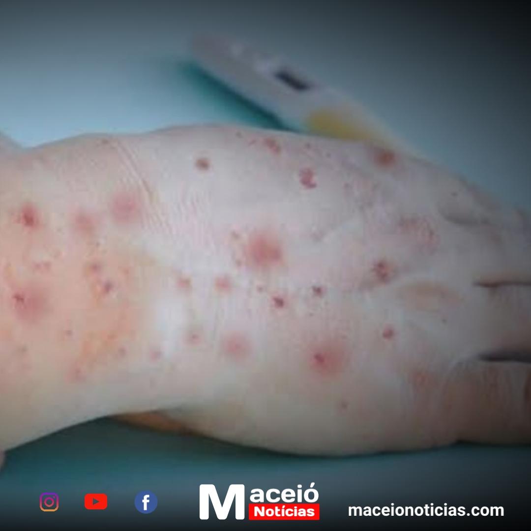Ministério da Saúde convoca reunião urgente sobre MPOX após registro de 709 casos no Brasil