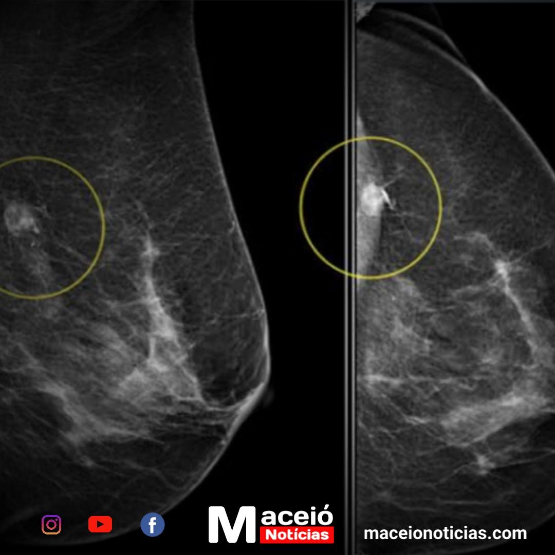 Nova tecnologia de IA identifica Câncer de Mama com 4 anos de antecedência