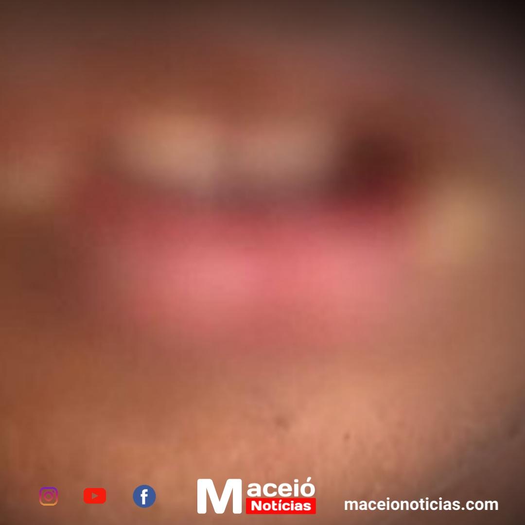 Maceió: Avó é detida por punir neto de 10 anos com ovo quente na boca